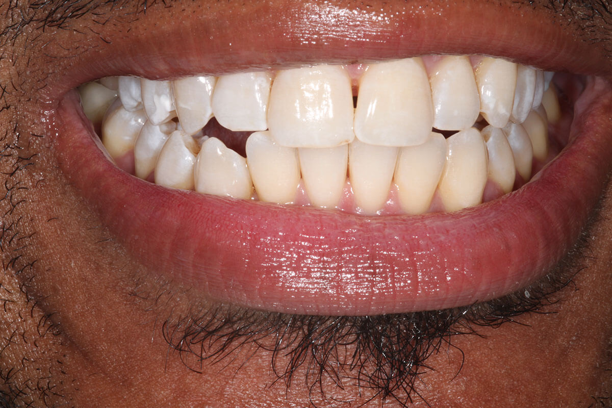 close up of man's mouth after teeth whitening