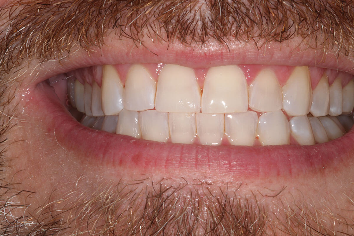 close up of man's mouth after teeth whitening