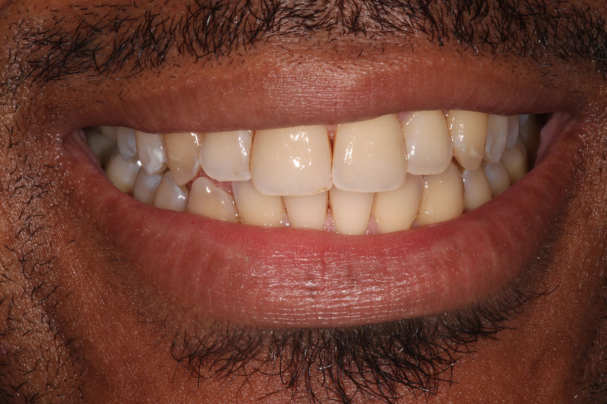 close up of man's mouth before teeth whitening