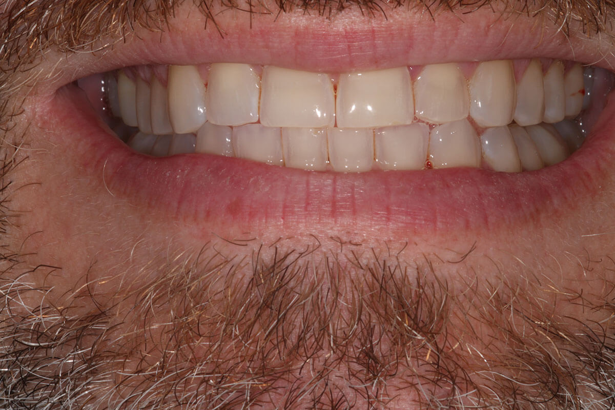 close up of man's mouth before teeth whitening