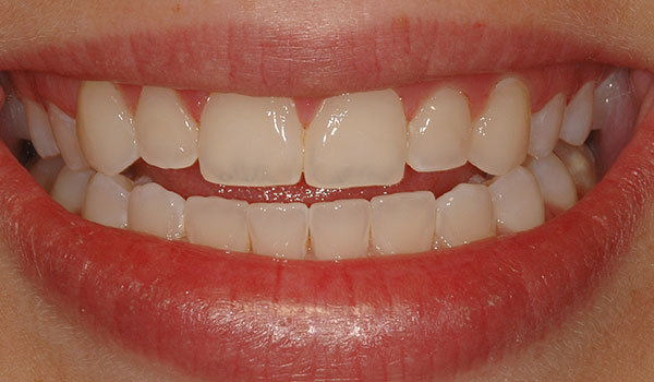 Bonded-Fillings_After