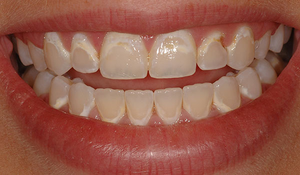 Bonded-Fillings_Before