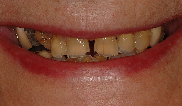 Full-Mouth-Rehab-before