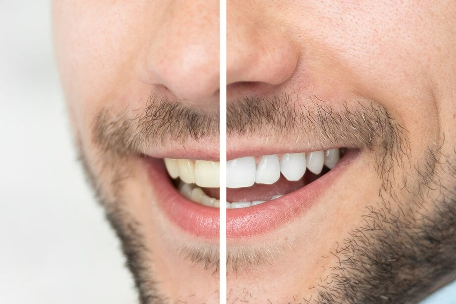 How Do You Whiten Teeth