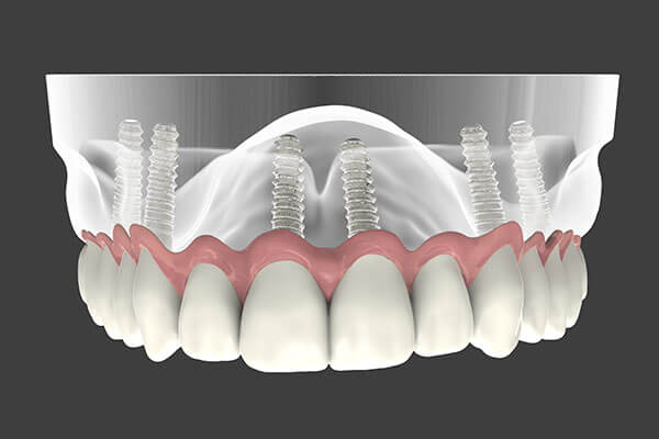 Implant Supported Dentures in NYC