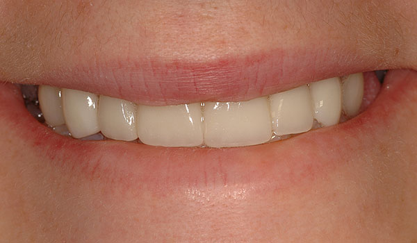 Invisalign-and-porcelain-veneers-after