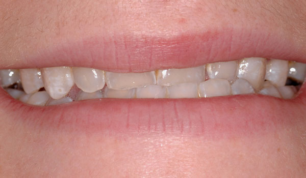 Invisalign-and-porcelain-veneers-before