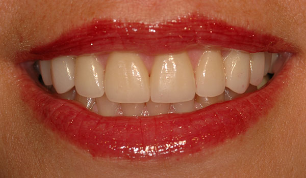 Natural-smile-with-veneers-after