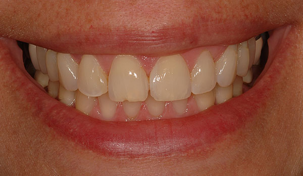 Natural-smile-with-veneers-before