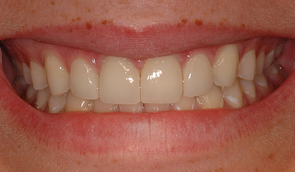 Porcelain-veneers-to-close-space-after