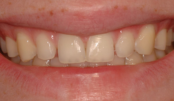 Porcelain-veneers-to-close-space-before