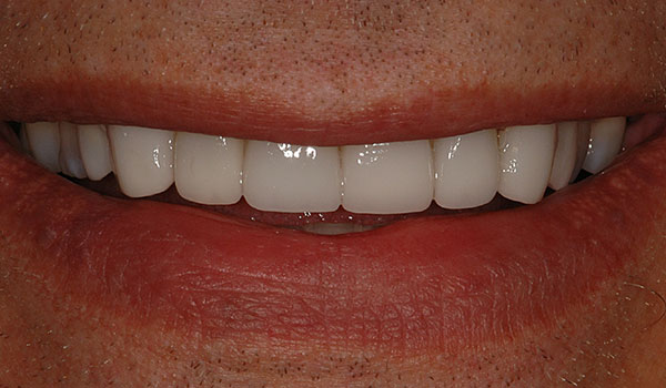 Patient After