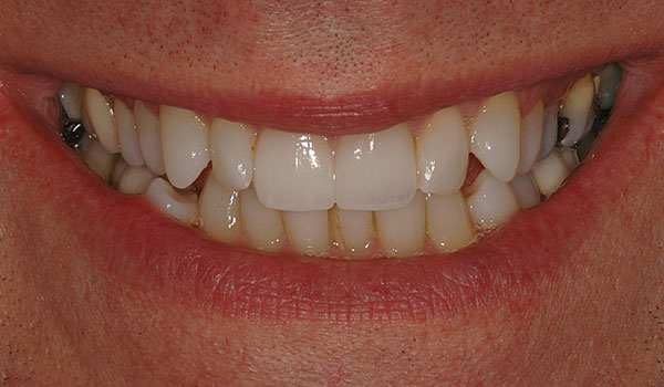 teeth whitening and crowns after