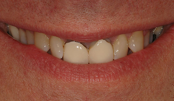 teeth whitening and crowns before