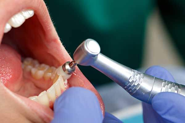 dentist polishing patient's teeth