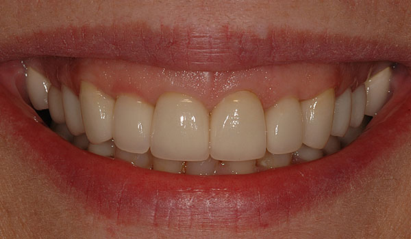 Upper teeth crowns after
