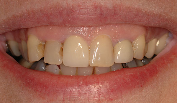 Upper teeth crowns before