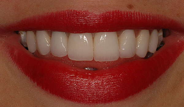smile with crowns and veneers after