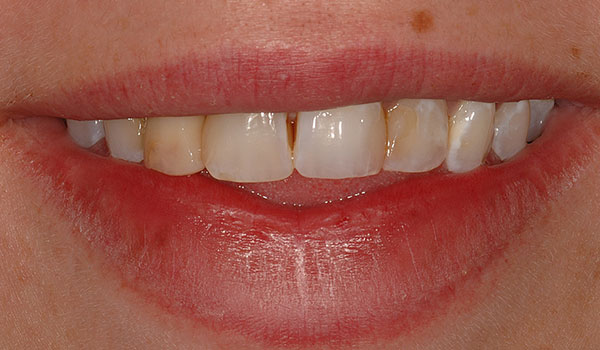 Smile with crowns and veneers before