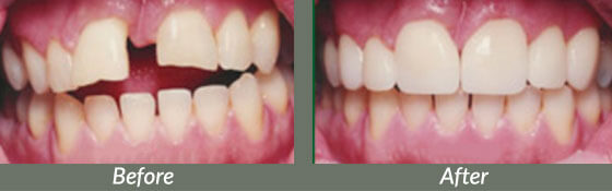 before and after pictures of mouth with veneers