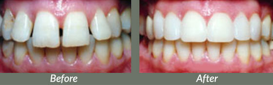 before and after pictures of mouth with veneers