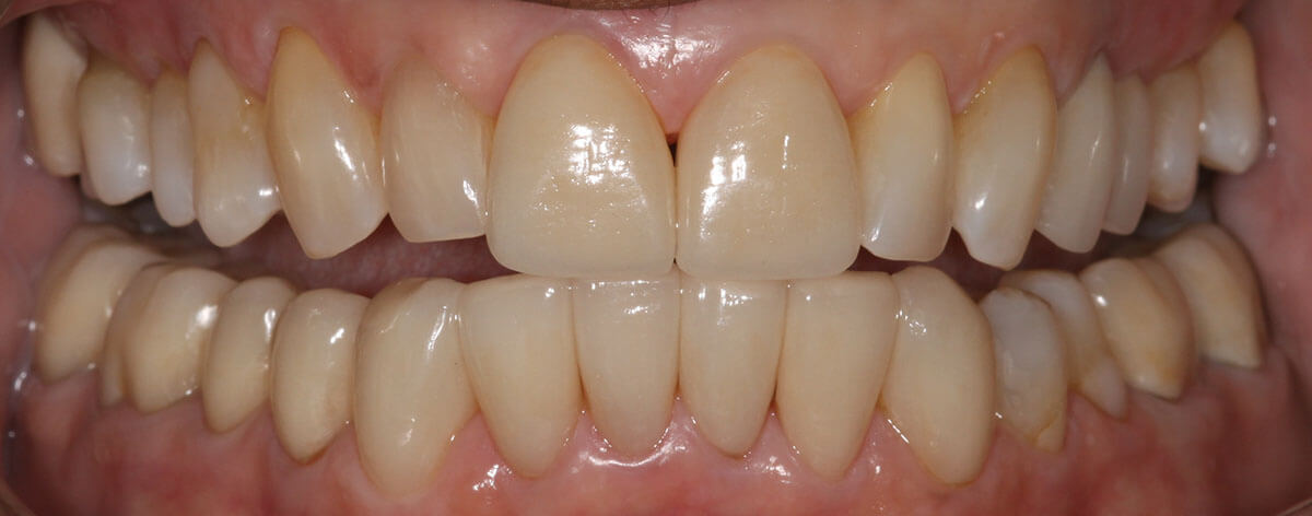 close up of open mouth and teeth