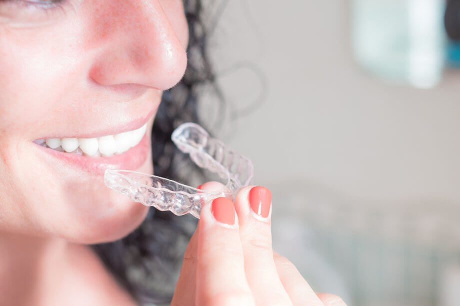 Can Invisalign Fix An Underbite?