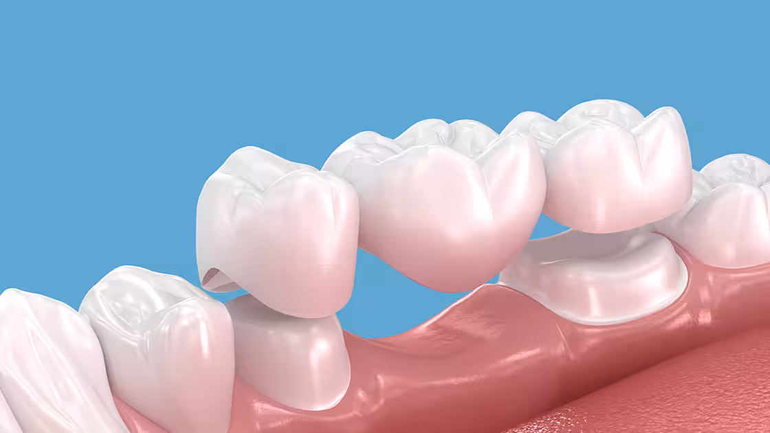 Dental bridge graphic