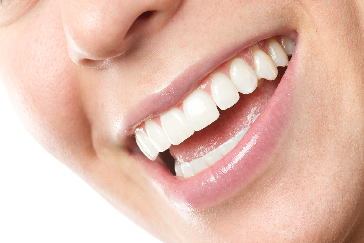 How Long Do Veneers Last? New York