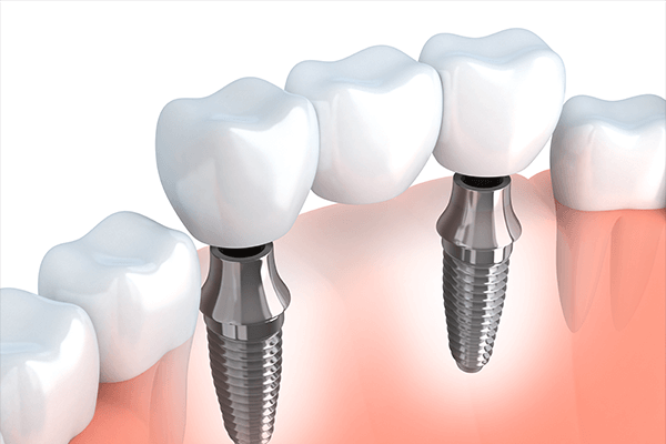 Implant Supported Bridges in NYC