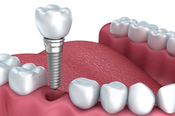 Implant Restorations in NYC