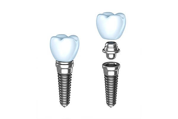 Single Dental Implant in NYC