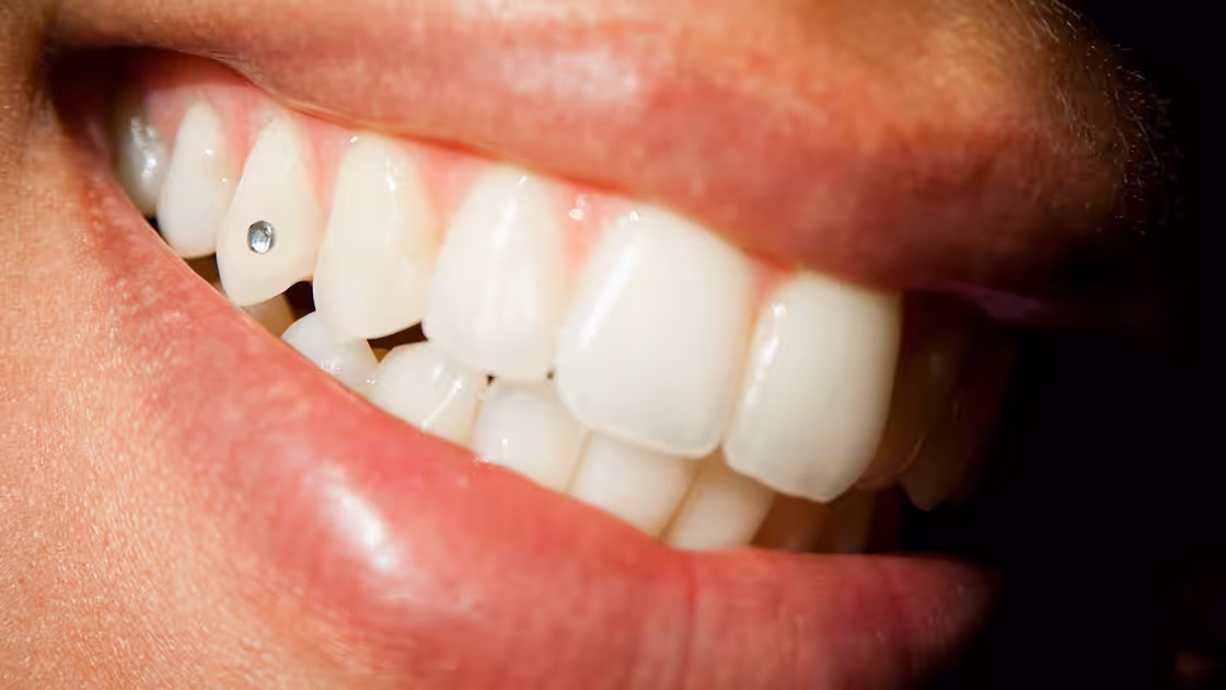 Tooth jewel
