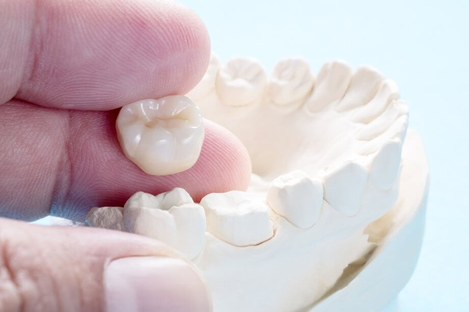 What Are Dental Crowns Made Of?