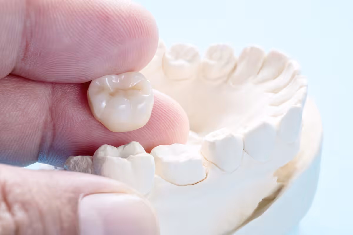 What are dental crowns made of blog