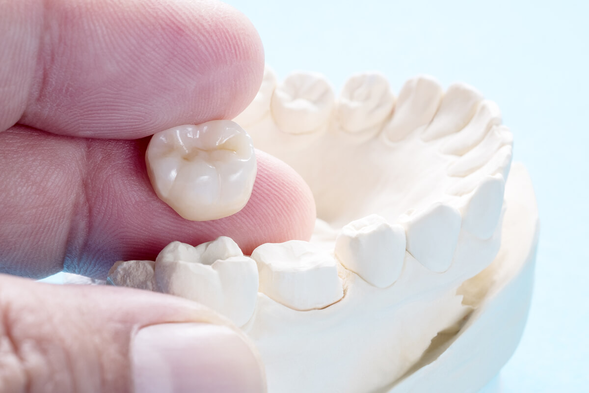 What Are Dental Crowns Made Of? Cosmetic Dentistry