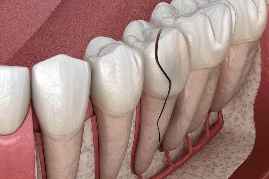 What Do I Do If My Tooth Is Cracked Underneath My Crown?