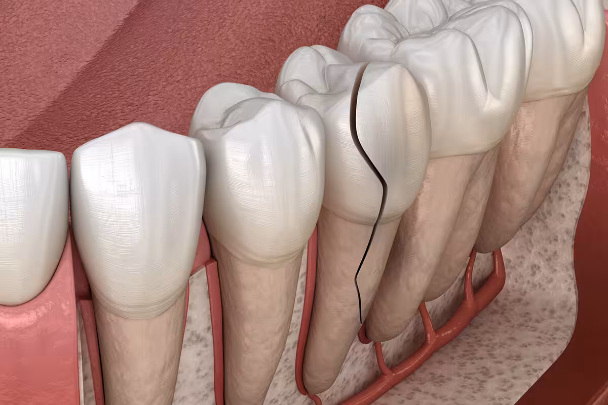 What do i do if my tooth is cracked underneath my crown blog