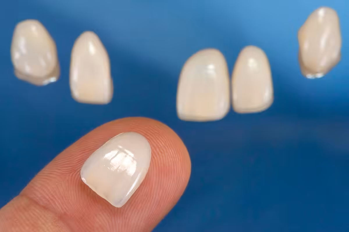 What is the process of getting veneers on the upper west side blog