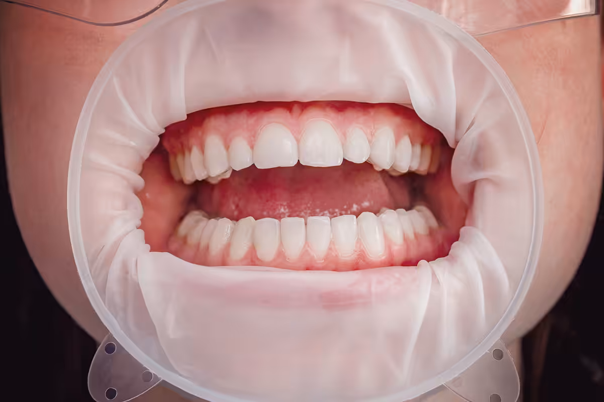 What to expect when getting full mouth restoration on the upper westside blog