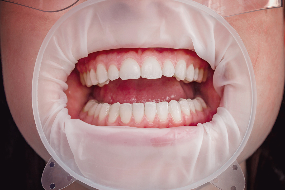 Full Mouth Restoration on the Upper Westside What to Expect